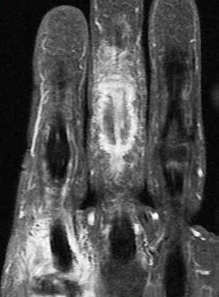 Figure 3 for case gout arthritis ( RID3567 )